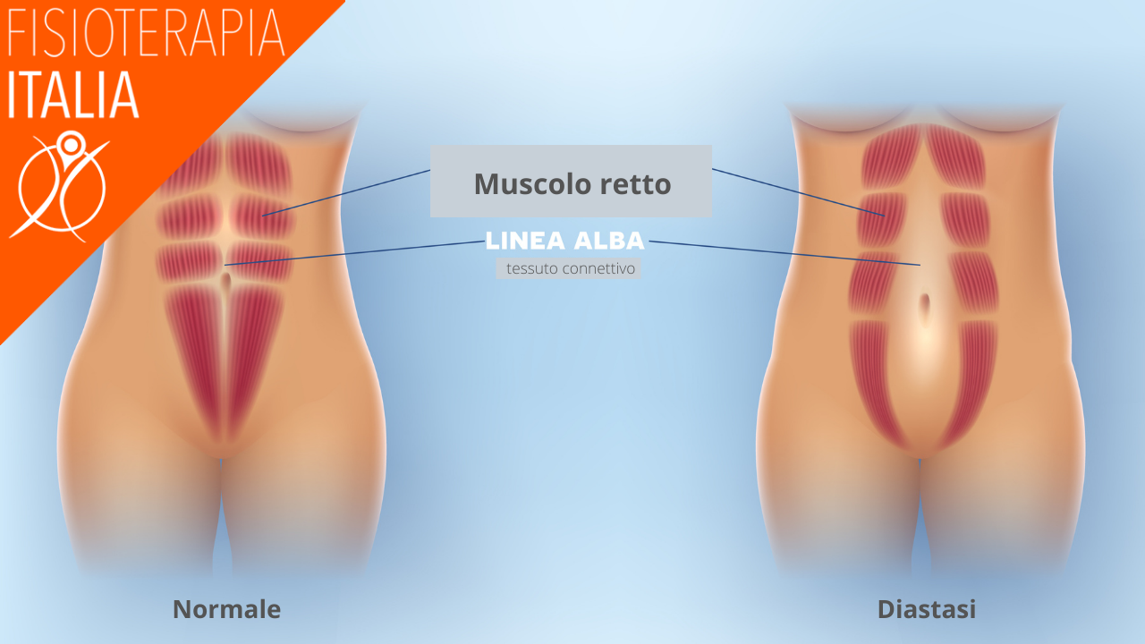 diastasi addominale