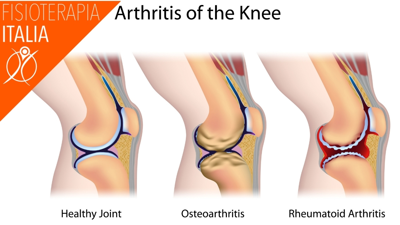 differenza tra artrosi e artrite