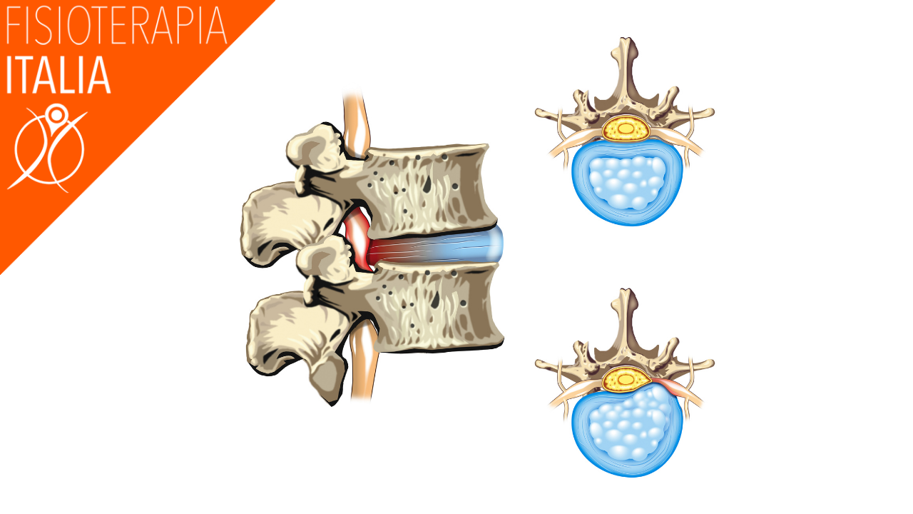 dischi intervertebrali cosa sono