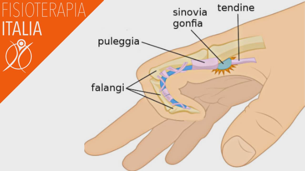 dito a scatto le pulegge e i tendini