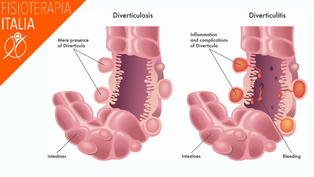 dolore al fianco sinistro diverticoli