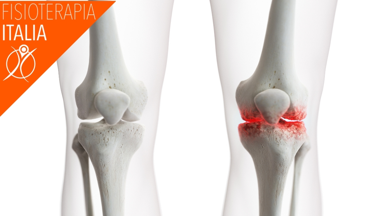 effetti del artrosi ginocchio