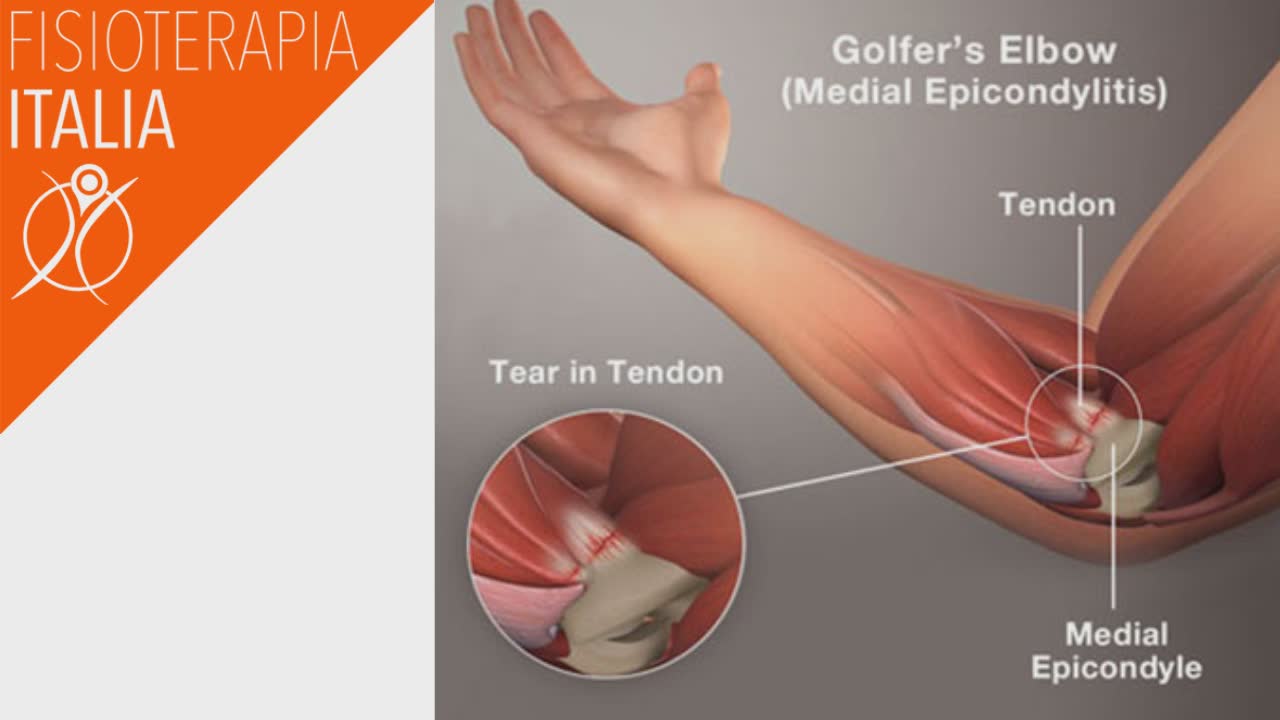 epitrocleite infiammazione del tendine