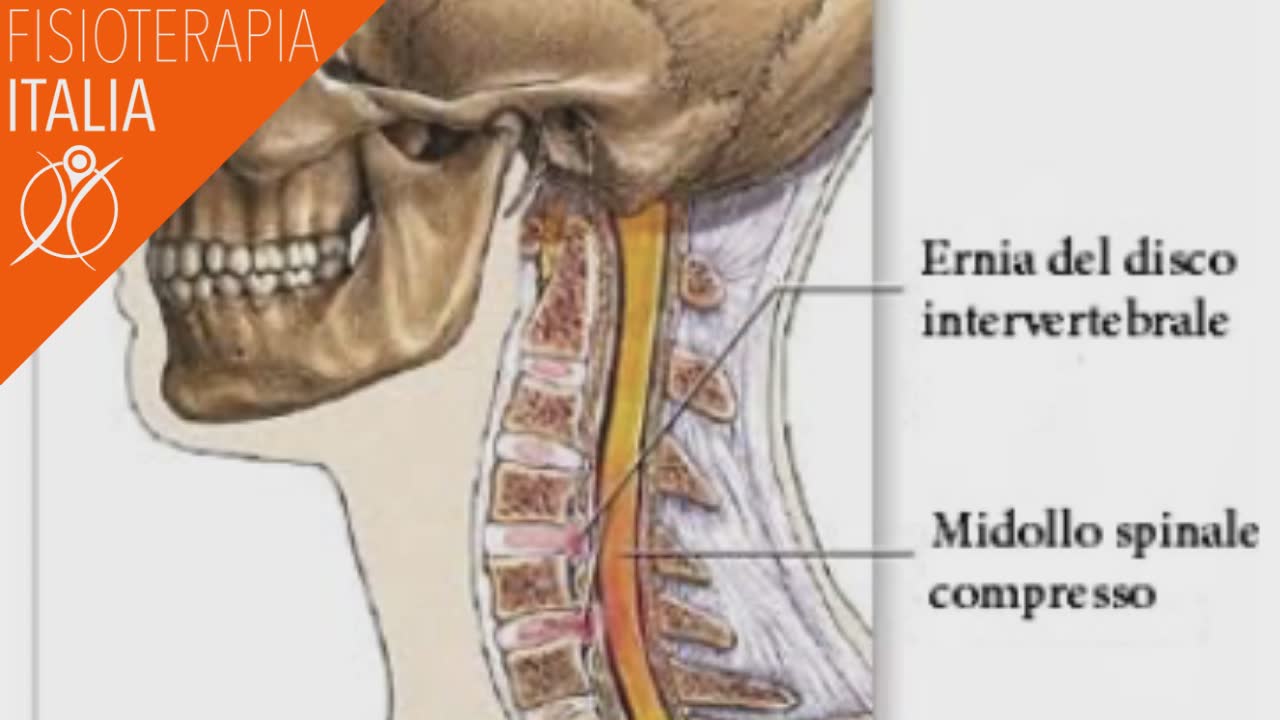 ernia del disco cervicale intervertebrale