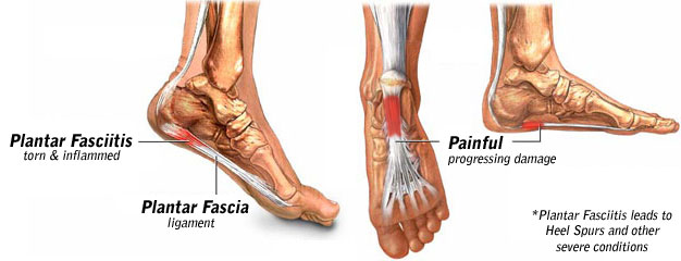 Fascite plantare