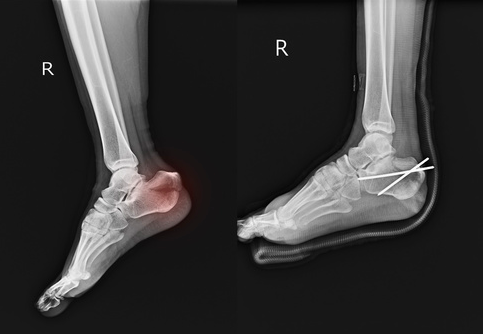 frattura del piede diagnosi e intervento terapeutico