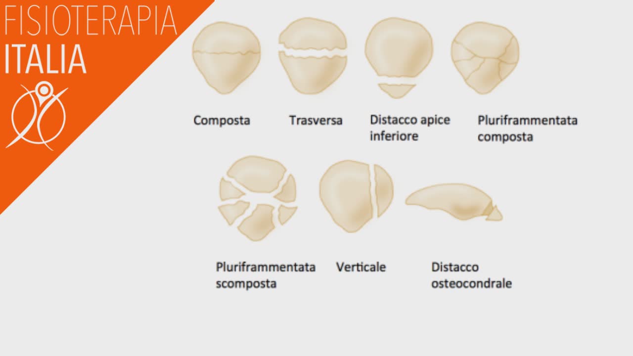 Le Fratture Del Ginocchio E L Intervento Della Fisioterapia