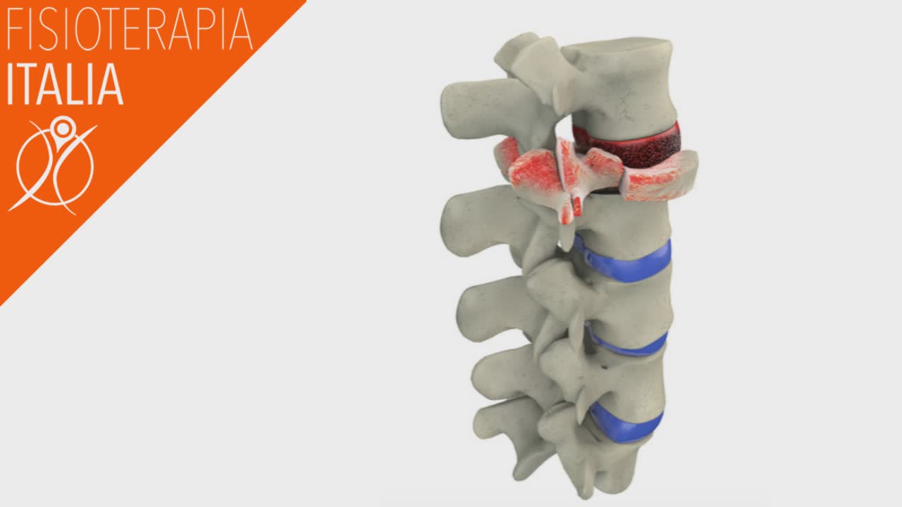 fratture vertebre dorsali diverse forme e interventi