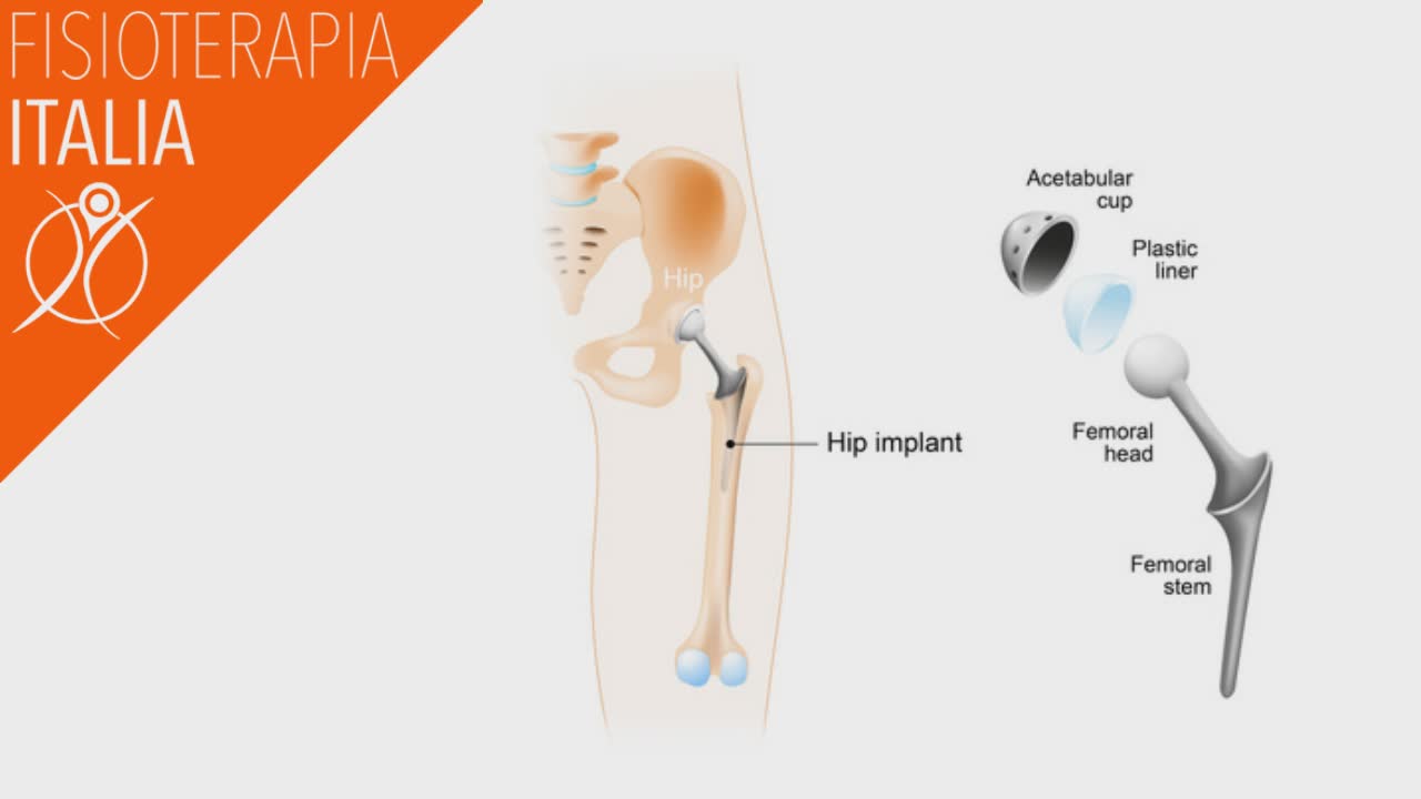 la protesi d'anca la fisioterapia nel post chirurgico