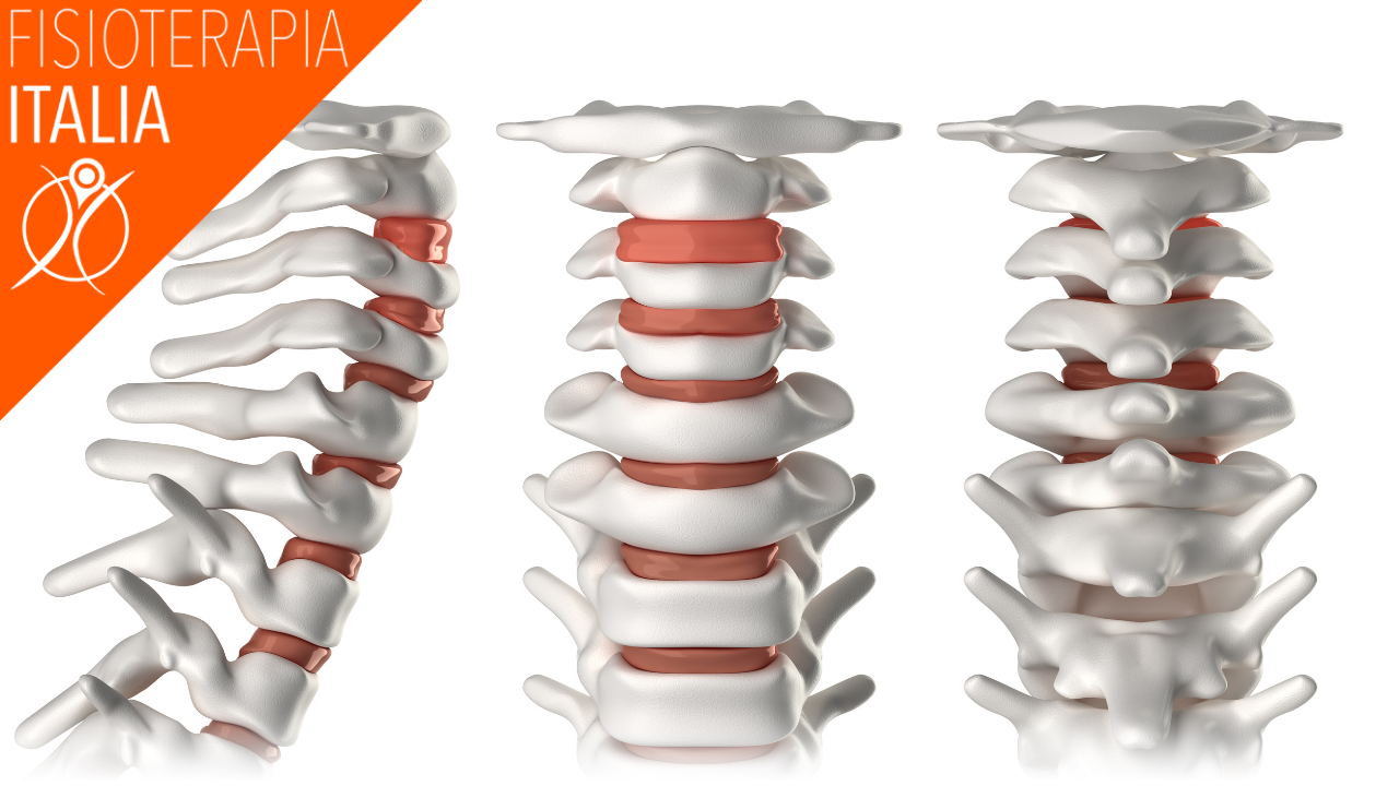 la spondilolistesi cervicale