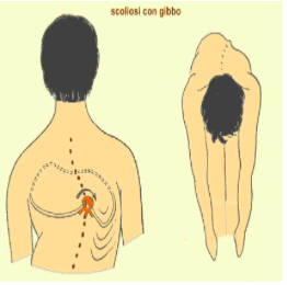 la scoliosi come si modifica il corpo e cosa comporta