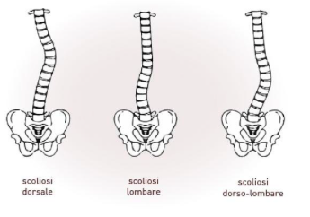 la scoliosi diverse forme e cure