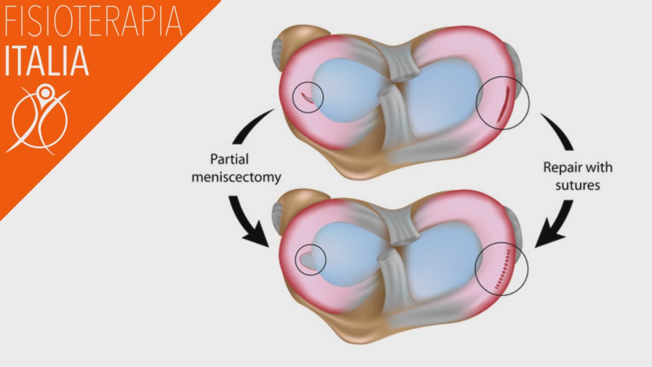 lesioni del menisco come interviene la chirurgia