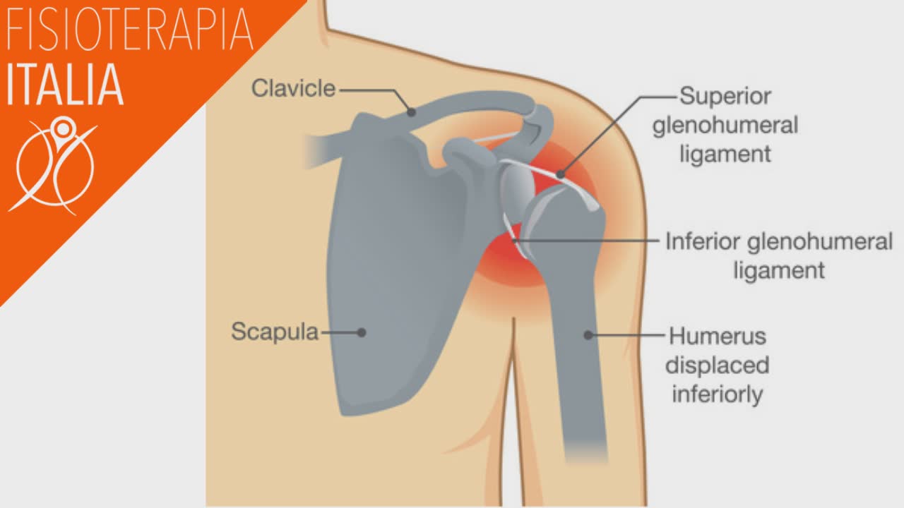 lussazione della spalla cos'è e come si cura