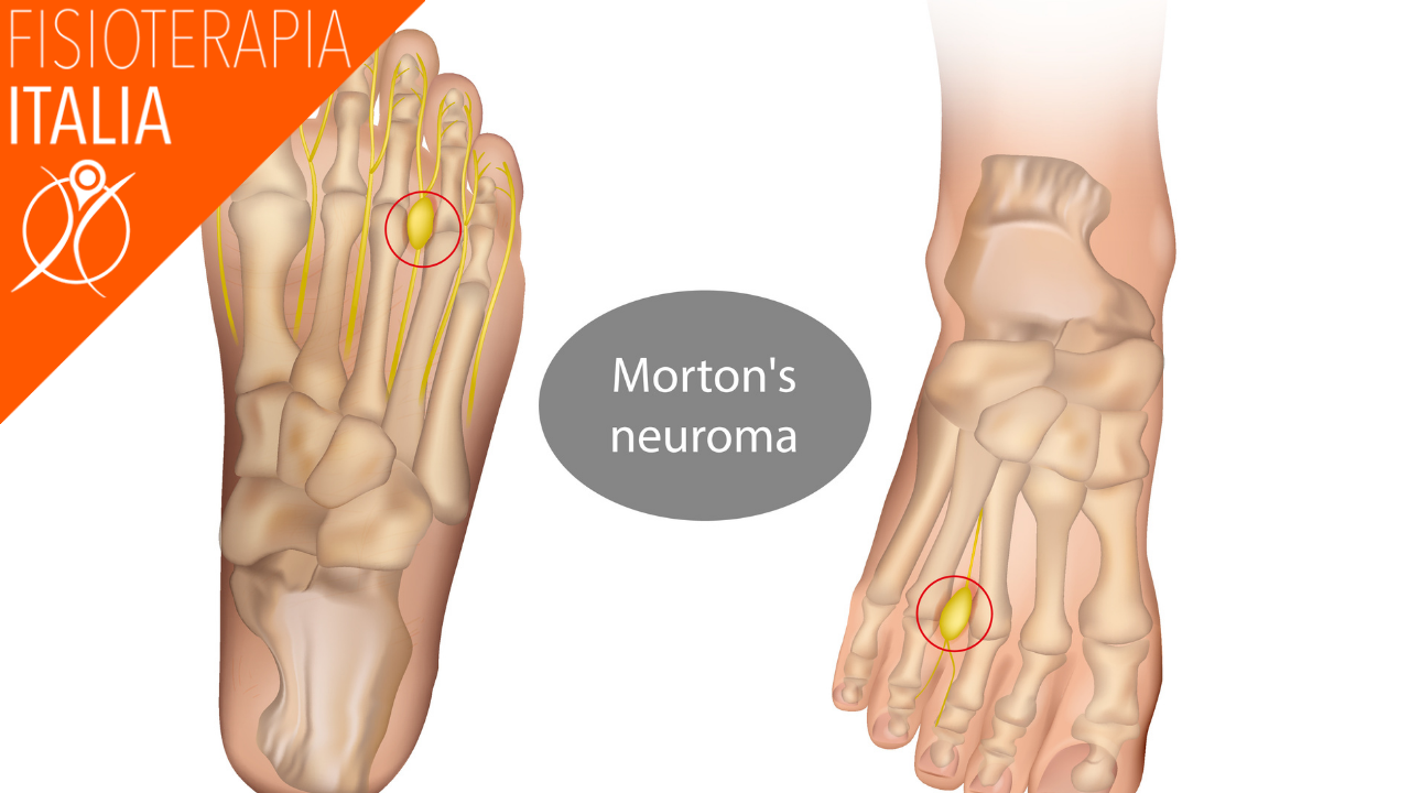 neuroma di morton