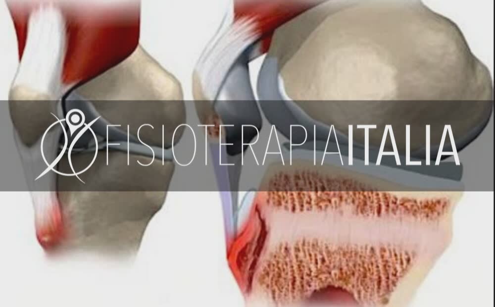 Morbo di Osgood-Schlatter