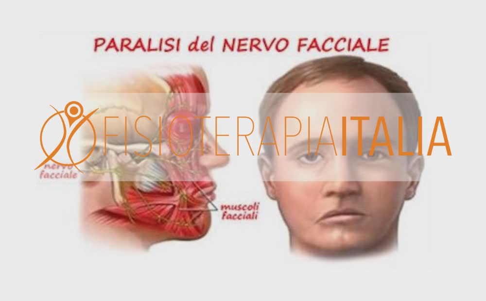 Paralisi di Bell