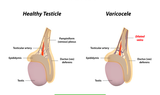 pubalgia e diagnosi differenziale con il varicocele