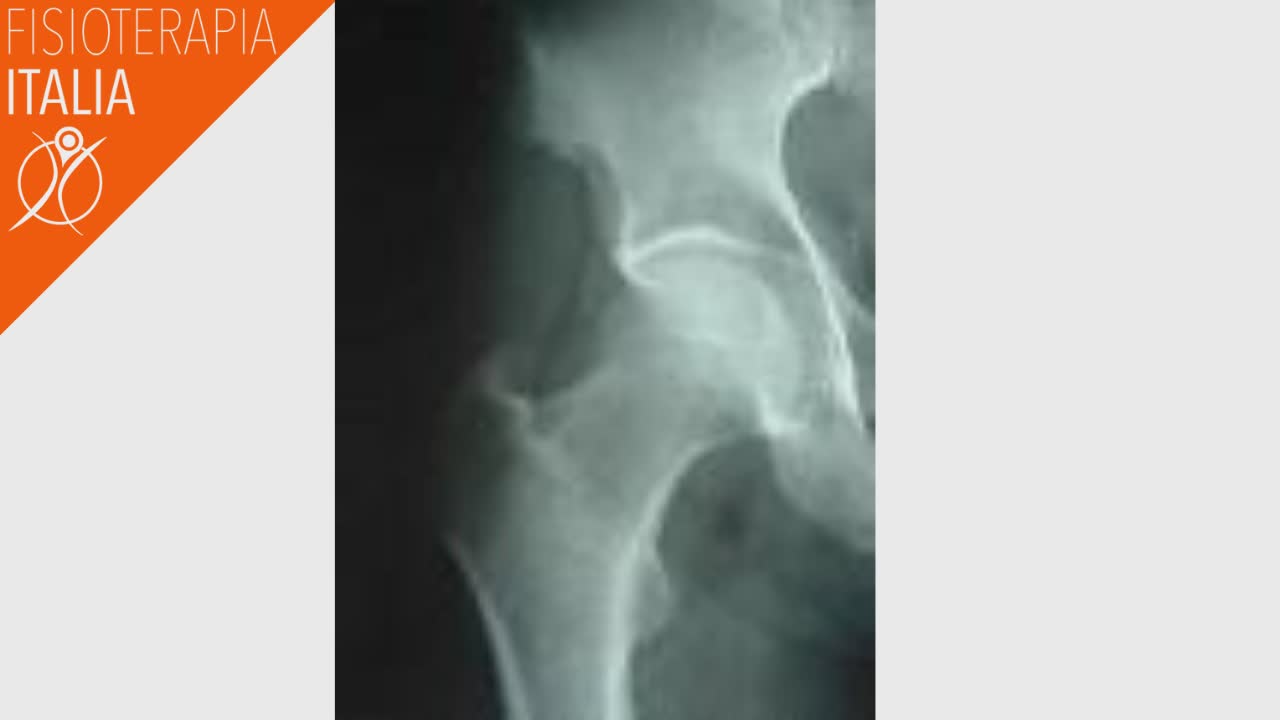 radiografia artrosi