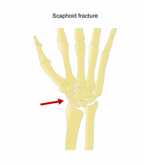 scafoide frattura