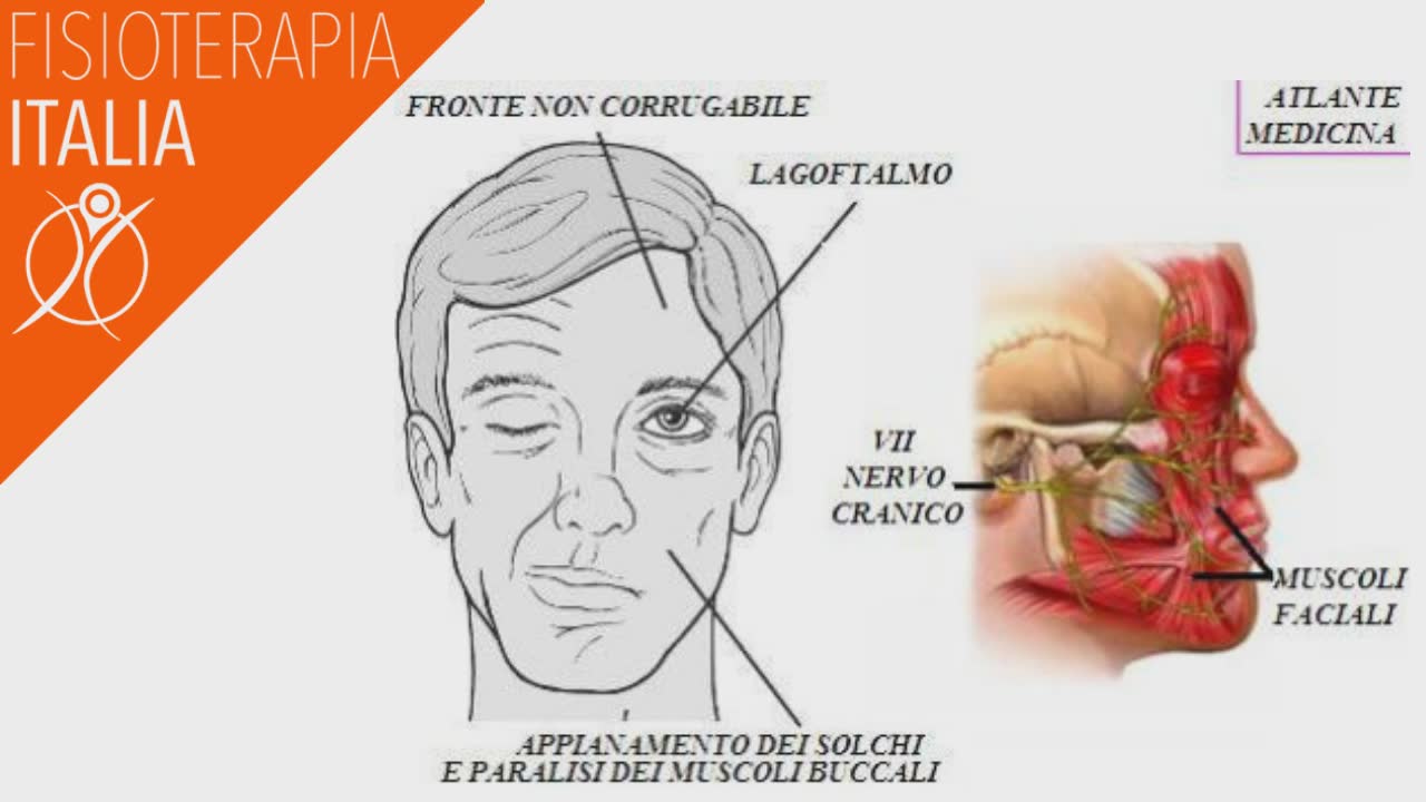 segni clinici della paralisi di bell