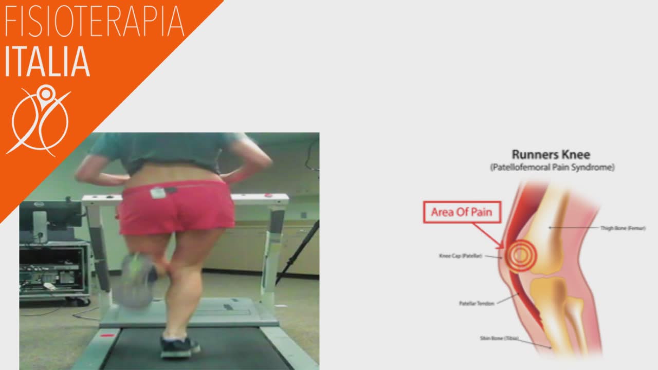 sindrome femoro rotulea allenamento neuromuscolare