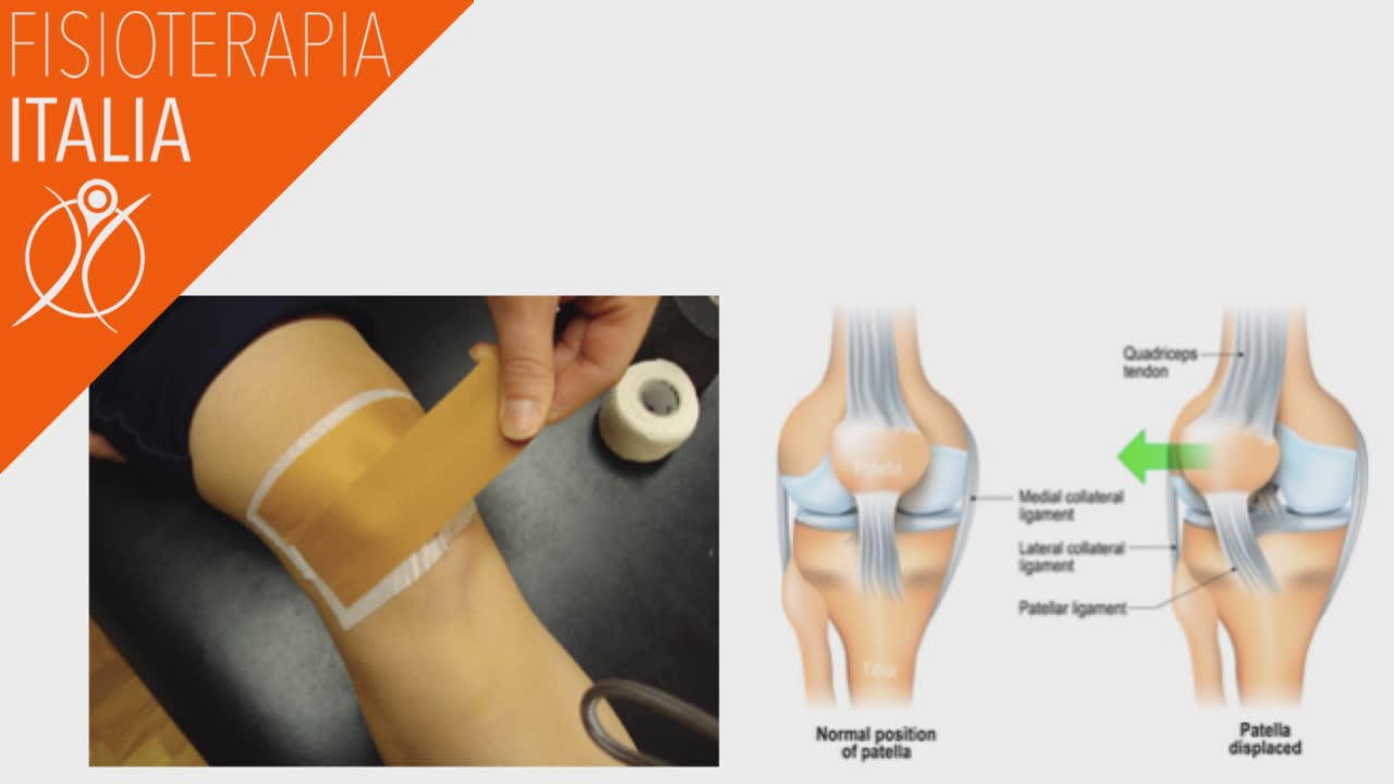 sindrome femoro rotulea taping patellofemorale