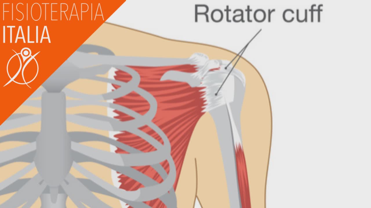 spalla cuffia dei rotatori infiammazione e lesione