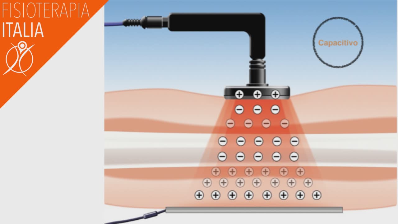 tecarterapia funzionamento sistema capacitivo