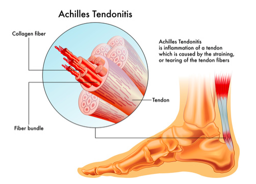tendine d'Achille e percorso terapeutico
