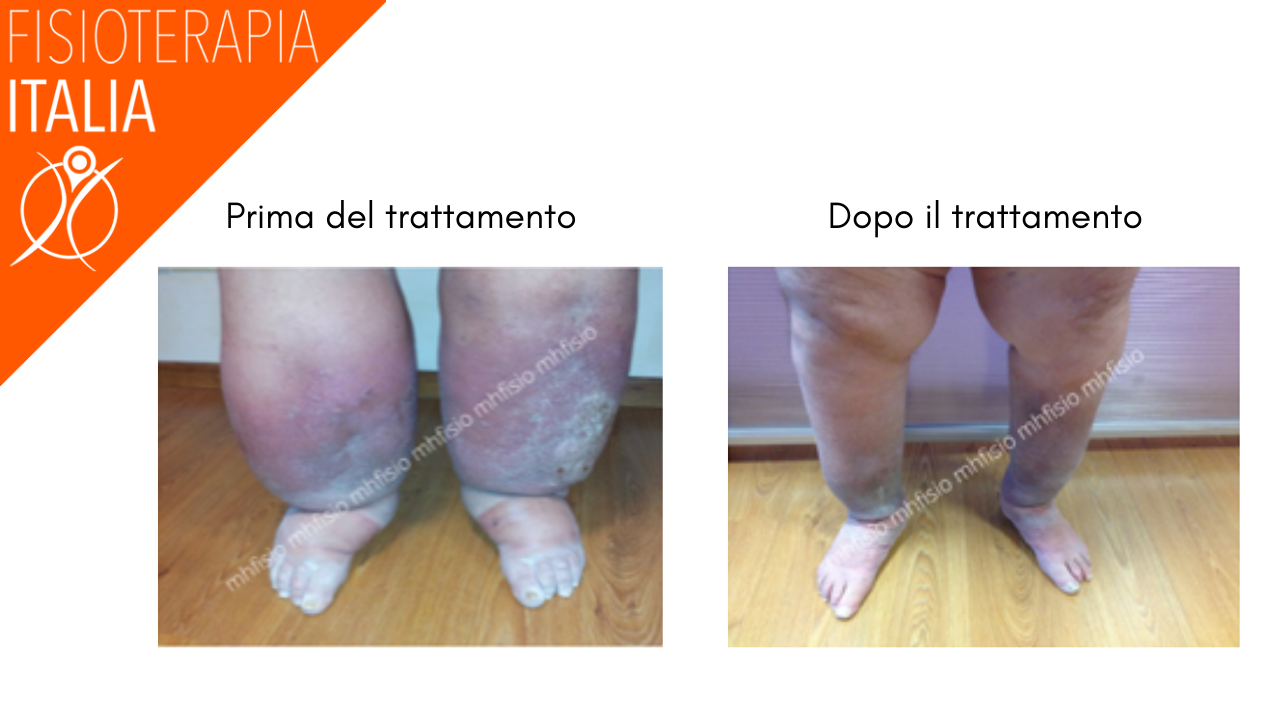 trattamento linfedema 