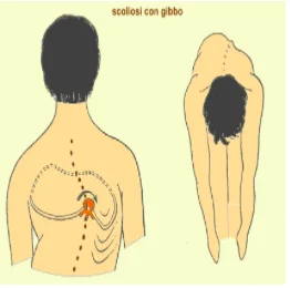 la scoliosi come si modifica il corpo e cosa comporta