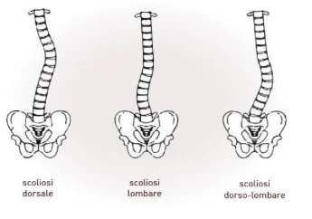 la scoliosi diverse forme e cure
